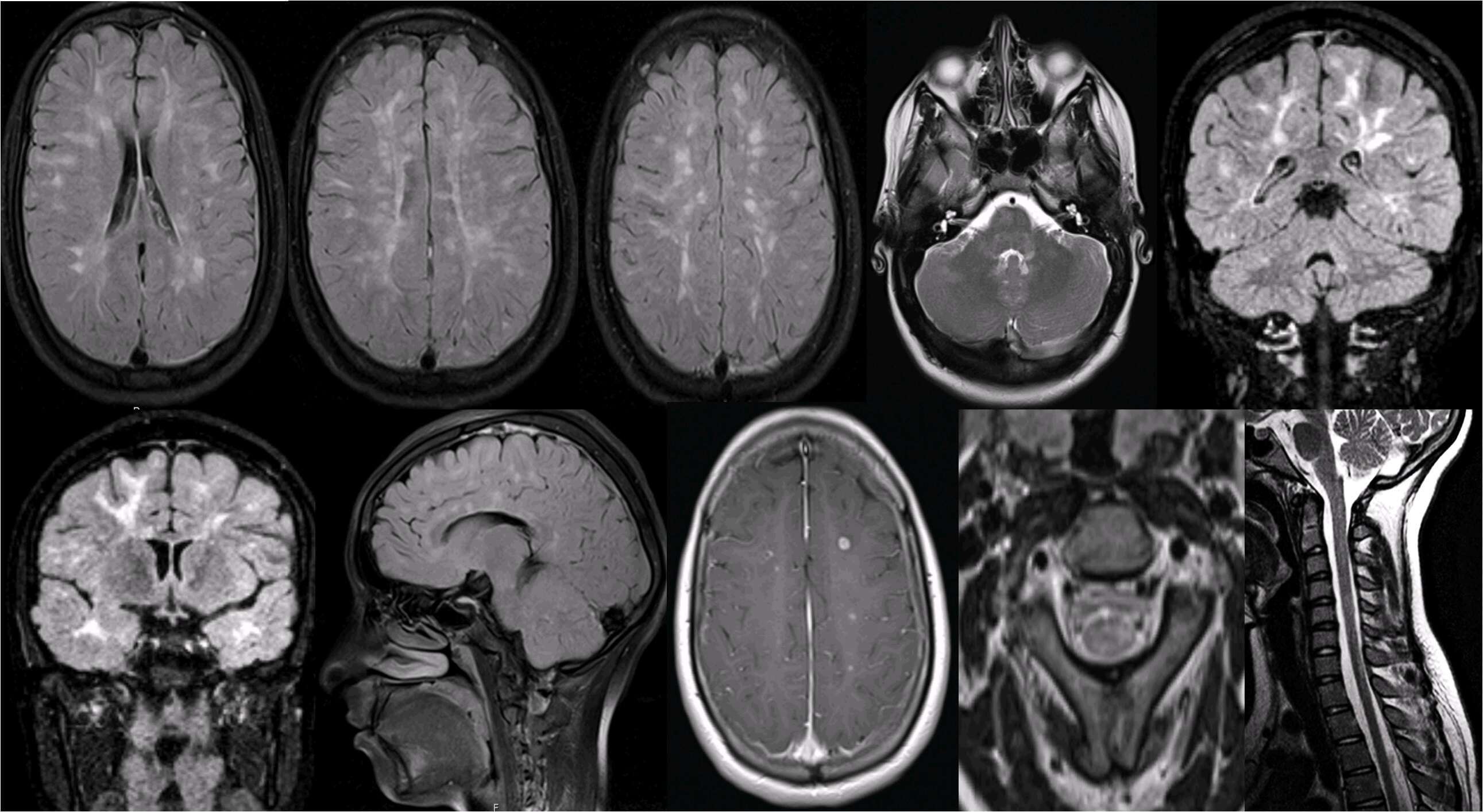 Fig. 1: Axial images FLAIR (AC), axial T2 (D), coronal (E and F) and sagittal (G) FLAIR, showing numerous focal or confluent white matter lesions (periventricular, subcortical, protuberance and cerebellum). Axial image T1 (H) after administration of gadolinium shows several lesions in the active phase. Axial (I) and T2 (J) images in the cervical segment of the spine showing spinal lesions.